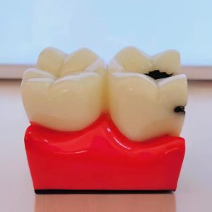D-17-Maquetas dentales